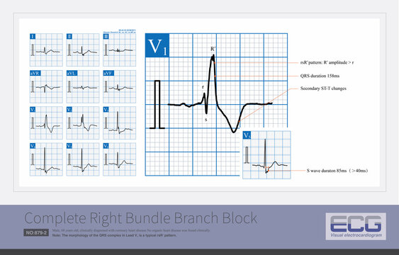 A 68-year-old male was clinically diagnosed with coronary heart disease. Over a period of eight months, the QRS duration progressively widened until complete right bundle branch block developed.
