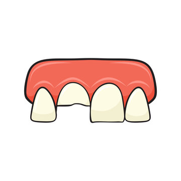 Partial Tooth Avulsion Illustration 