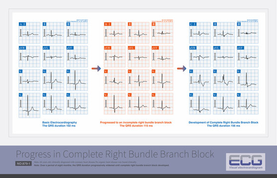 A 68-year-old male was clinically diagnosed with coronary heart disease. Over a period of eight months, the QRS duration progressively widened until complete right bundle branch block developed.
