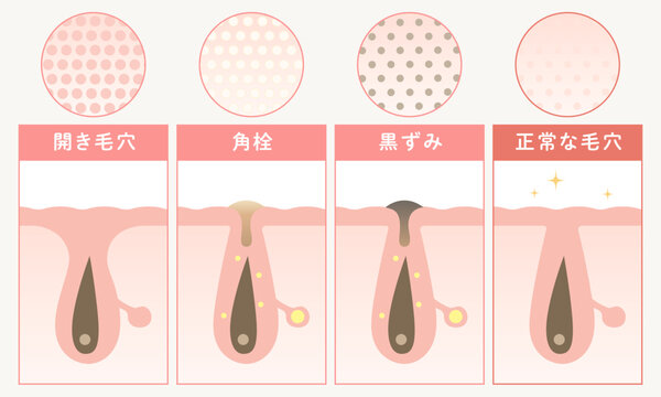 毛穴トラブルの比較図解｜開き毛穴・角栓・黒ずみ・正常な毛穴の美容ベクター素材