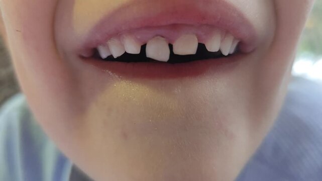 An extreme close-up video focusing on a child's open mouth, clearly showing the loose front teeth and the surrounding gums during the transition to permanent teeth.
