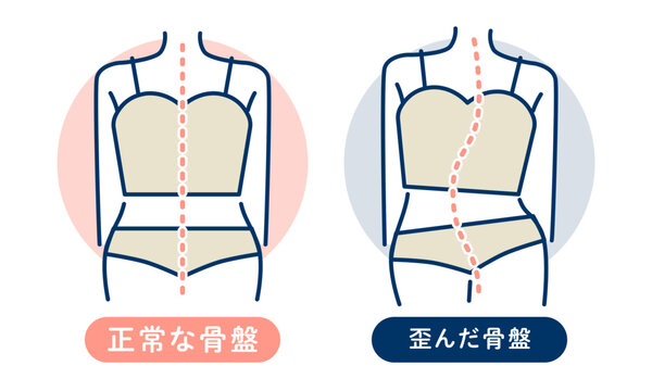 正常な骨盤と歪んだ骨盤の比較図解｜背骨・姿勢・骨盤の歪み・ボディバランスの健康ベクター素材