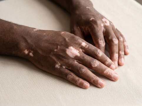 Close-up of dark skin hands with vitiligo showing depigmented white patches on fingers and wrists, autoimmune pigmentation skin condition concept