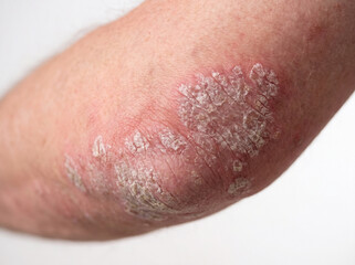 Fototapeta premium Close-up of psoriasis plaques on human elbow showing red inflamed skin with silvery white scaly patches, dermatology skin condition concept