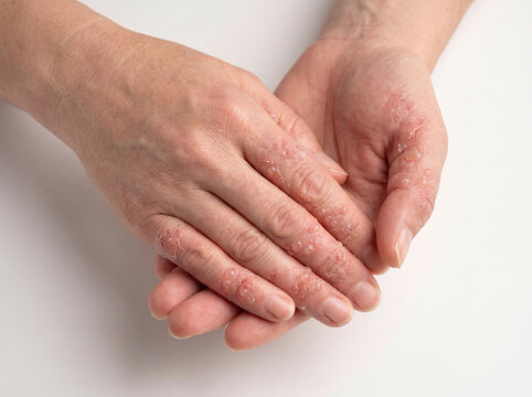 Adult hands with dyshidrotic eczema showing blisters dry cracked red skin on fingers, hand dermatitis skin condition medical concept