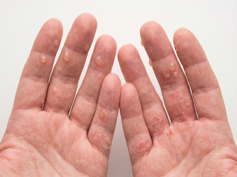Adult hands with dyshidrotic eczema showing blisters dry cracked red skin on fingers, hand dermatitis skin condition medical concept