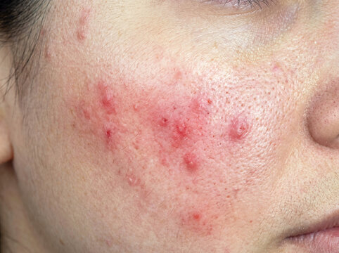 Severe facial acne, inflamed red skin with painful pustules and blemishes. Close-up of a woman's cheek, showcasing a common dermatological condition and skin health issue.