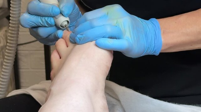 Onychomycosis. The process of treating toenails by a doctor. A dangerous fungal infection of toenails in a person sitting in an examination chair. Disease and detachment of the nail plate