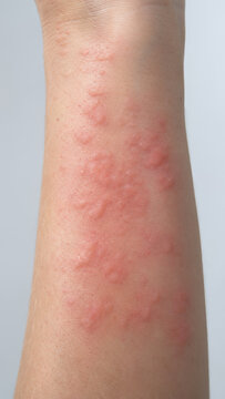 Close-up of red skin rash with hives on human arm. Allergic reaction or dermatitis inflammation on isolated light gray background. Allergy symptoms with copy-space.