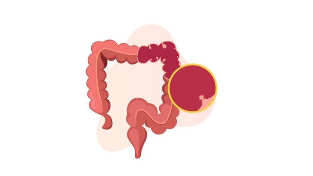 Colon Polyps  - An Abnormal Tissue Growths - Stock Animated Illustration as MP4 File