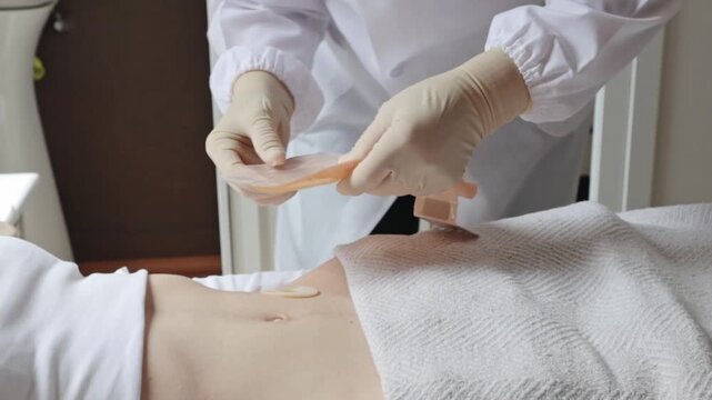 A nurse places a colostomy bag on a patient's abdomen.