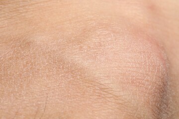 Fototapeta premium Texture of dry skin as background, closeup