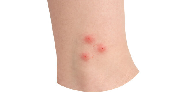 Red itchy insect bites on human skin leg