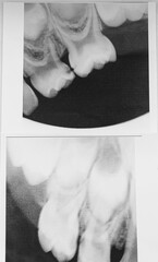 Black and white dental X-ray showing upper teeth and roots. Concept of dentistry, oral health, medical diagnostics, and dental care © leroy