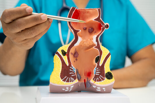 Asian doctor with rectum and hemorrhoid human anatomy model at hospital, inflamed vascular structure.