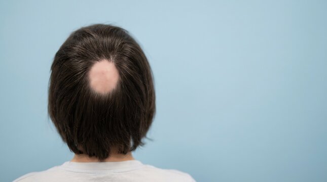 Back view of a person with a circular bald patch on the crown of the scalp against a blue background