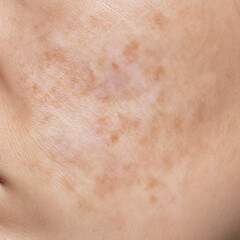 Fototapeta premium Skin close-up showing pigmentation irregularities and spots 