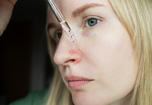 Close-up of woman applying serum with pipette on face with couperose and rosacea symptoms on nose. Professional skincare treatment for dilated capillaries and redness.