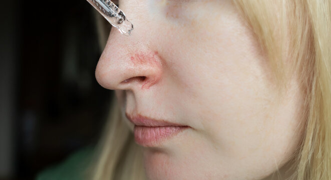 Close-up of woman applying serum with pipette on face with couperose and rosacea symptoms on nose. Professional skincare treatment for dilated capillaries and redness.