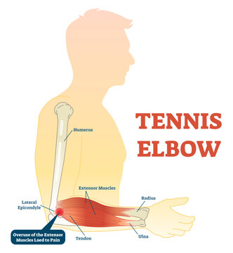 Tennis elbow medical fitness anatomy illustration diagram with arm bones, joint and muscles, transparent background. Overuse of extensor muscles leading to pain.