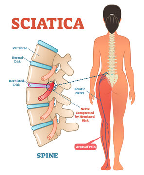 Sciatica medical health care illustration scheme with lower spine and sciatic nerve pain in leg, transparent background. Backbone diagram with vertebrae, disks and nerves.