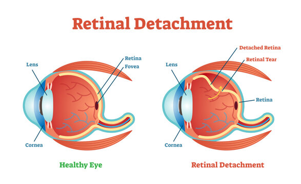 Retinal Detachment illustration diagram, anatomical scheme, transparent background. Medicinal educational information.
