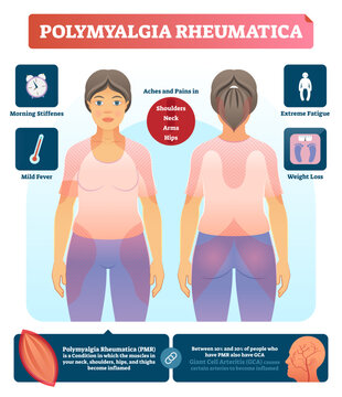 Polymyalgia rheumatica illustration, transparent background.Labeled diagnosis diagram.Medical and anatomical infographic with symptoms, problem zones and consequences.
