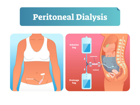 Peritoneal dialysis illustration, transparent background. Labeled scheme with method to exchange fluids after surgery. Isolated internal catheter system explanation diagram.