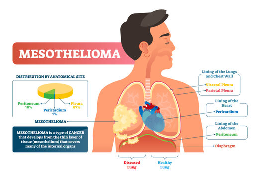 Mesothelioma illustration, transparent background. Labeled lung cancer educational scheme. Diagram with diseased lung structure and compared with healthy side. Asbestos illness with peritoneum.