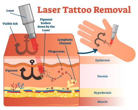 Laser tattoo removal illustration diagram, transparent background. Cosmetic dermatology visual information.