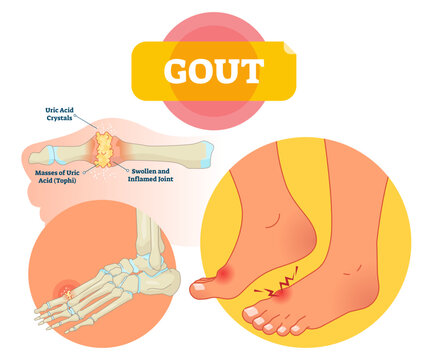 Gout illustration, transparent background. Medical labeled scheme with uric acid crystals, masses of tophi. Diagnosis of swollen and inflamed foot joint. Painful anatomical bone disease.