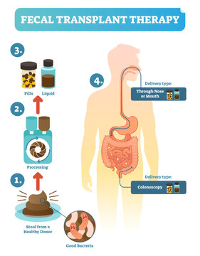 Fecal transplant therapy, procedure steps diagram, illustration, transparent background. Healing human digestive microflora.Taking healthy stool from donor, processing and delivering to human body.