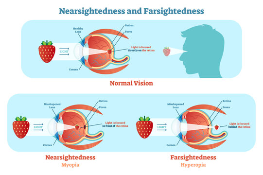 Far sightedness and Near sightedness illustration diagram, anatomical scheme, transparent background. Medical educational information.