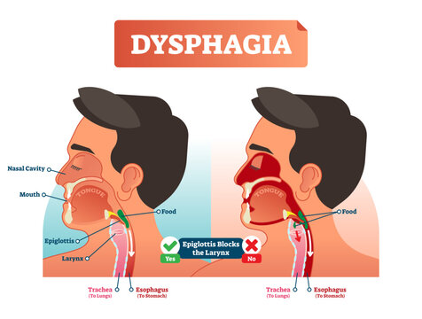 Vector illustration about dysphagia, transparent background. Human compered in scheme. Closeup head with nasal cavity, mouth, tongue, trachea to lungs and esophagus to stomach.
