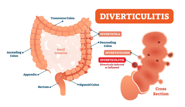 Diverticulitis illustration, transparent background. Labeled medical diagram with structure and location. Cross section scheme with diverticula infected or inflamed and diverticulosis.