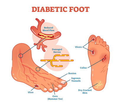 Diabetic foot medical illustration scheme with common foot conditions, transparent background.