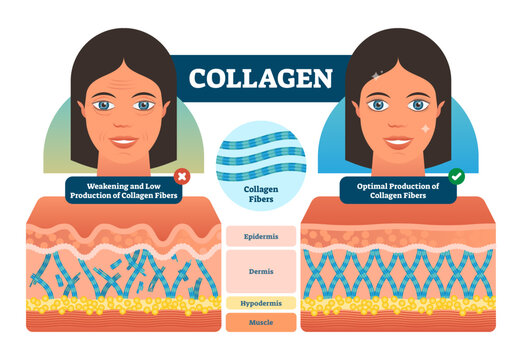 Collagen illustration, transparent background. Medical and anatomical labeled scheme with fibers, epidermis, hypodermis and muscle. Weakening low and optimal production compared diagram.