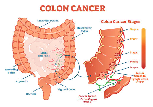 Colon cancer medical illustration scheme, anatomical diagram with cancer stages and spreading to other organs, transparent background.