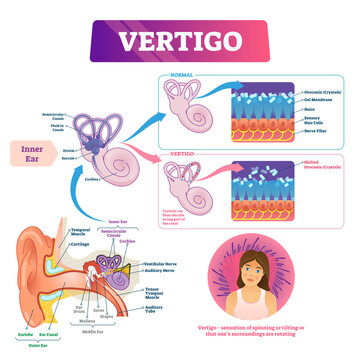 Vertigo illustration, transparent background.Labeled medical vestibular ear problem scheme.Anatomical inner earlobe and canal detailed structure.