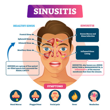 Sinusitis illustration, transparent background. Labeled rhinosinusitis inflammation scheme. Anatomical explanation with healthy and infection nasal illness comparison.