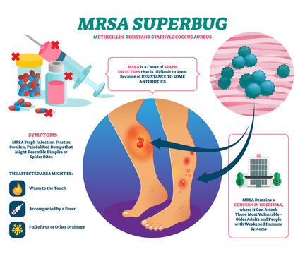 MRSA super bug illustration, transparent background. Labeled staph body infection explanation scheme. Medical strain of methicillin resistant Staphylococcus aureus bacteria.