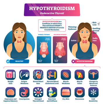 Hypothyroidism hormone produce illustration, transparent background. Labeled underactive thyroid explanation scheme. Anatomical endocrine system disease diagnosis, symptoms and compared.