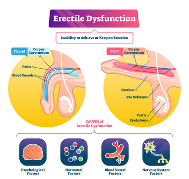 Erectile dysfunction illustration, transparent background. Labeled impotence explain scheme. Medical illness with sexual male issues. Fertility potency problem and flaccid penis disorder.