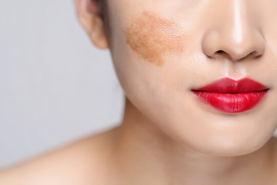 Woman's face with melasma and red lipstick close up skin hyperpigmentation