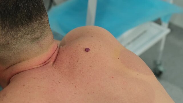 Man with large mole on back waits for checkup in dermatology clinic slow motion. Patient visits doctor for birthmark biopsy operation in hospital