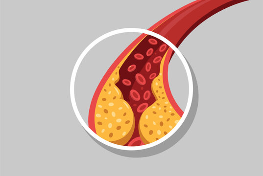 Close up medical illustration of an artery cross section showing the buildup of yellow cholesterol plaques obstructing the blood flow.