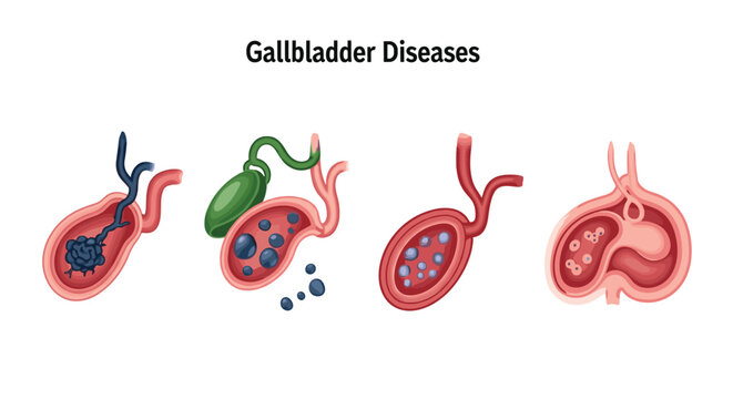 Medical illustration depicting various gallbladder diseases and conditions like gallstones and inflammation in different stages.
