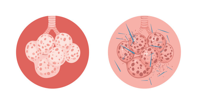 Medical illustration comparing healthy lung alveoli with those affected by infection or chronic obstructive pulmonary disease.