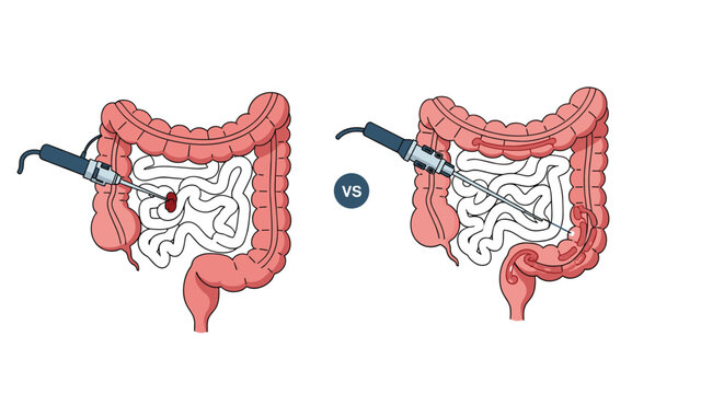Comparative diagram of surgical procedures on the large and small intestines using laparoscopic tools for medical education.