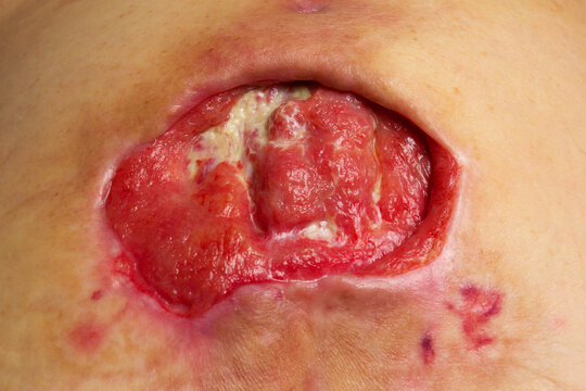 Close-up medical image of a severe stage 4 pressure ulcer (bedsore, decubitus ulcer) with granulation tissue and signs of chronic inflammation. Clinical wound care, surgery, rehabilitation 